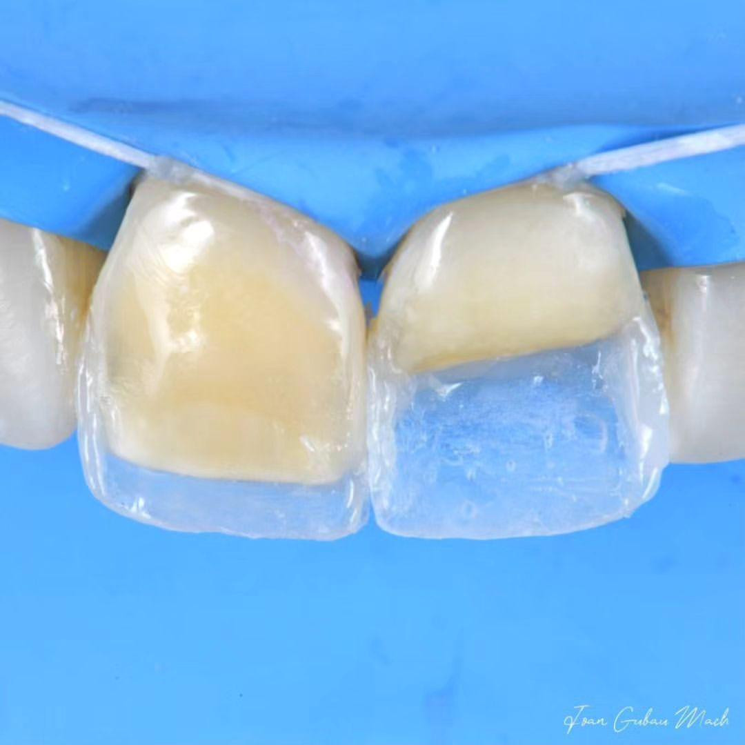 Direct Anterior Composites